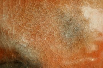Melanoma: la amenaza silenciosa bajo la piel