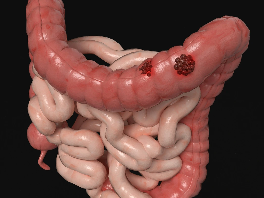 Mes de la Concientización del Síndrome del Intestino Irritable