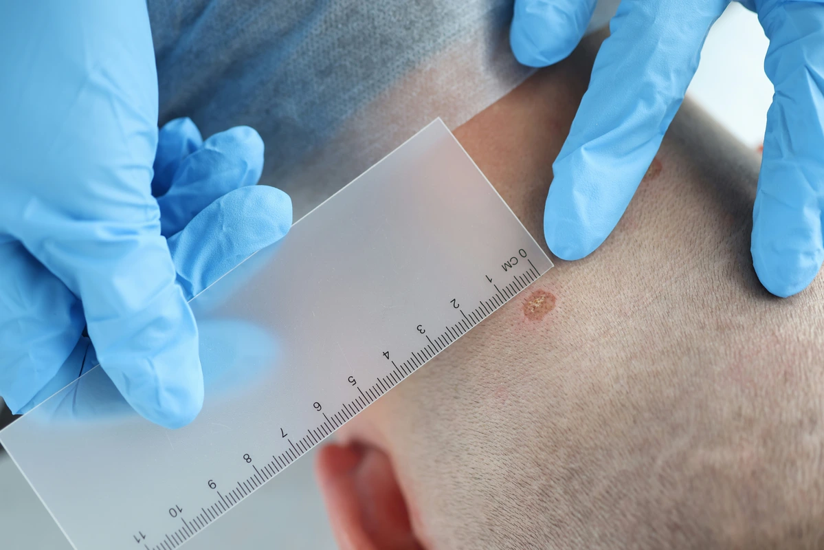 Día Mundial del Melanoma: La importancia de proteger nuestra piel