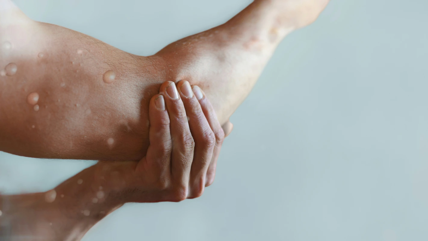 La hidradenitis supurativa y la importancia de aumentar la concienciación