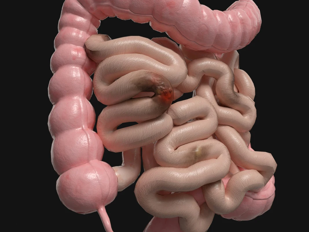 Colitis ulcerativa en remisión: estrategias para mantener el control a largo plazo