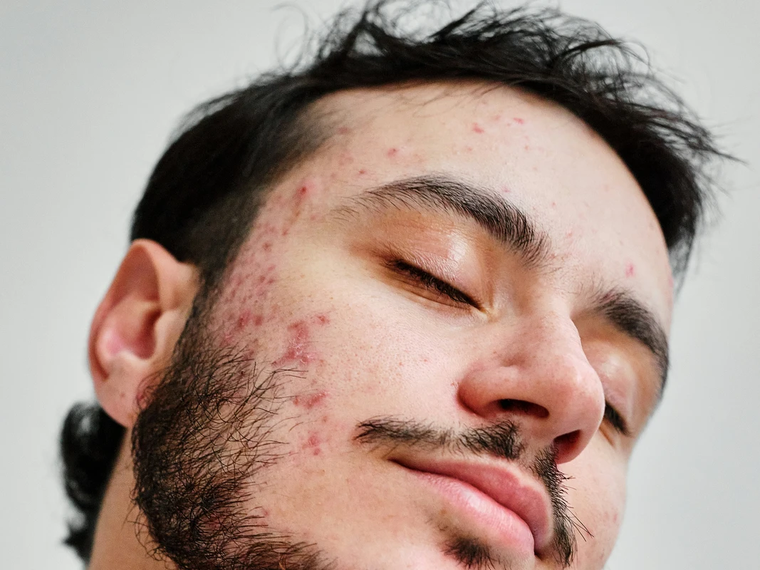 Dermatitis de contacto: identificando los desencadenantes ocultos en el hogar y el trabajo